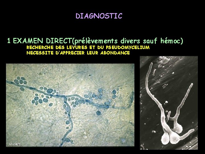 DIAGNOSTIC 1 EXAMEN DIRECT(prélèvements divers sauf hémoc) RECHERCHE DES LEVURES ET DU PSEUDOMYCELIUM NECESSITE