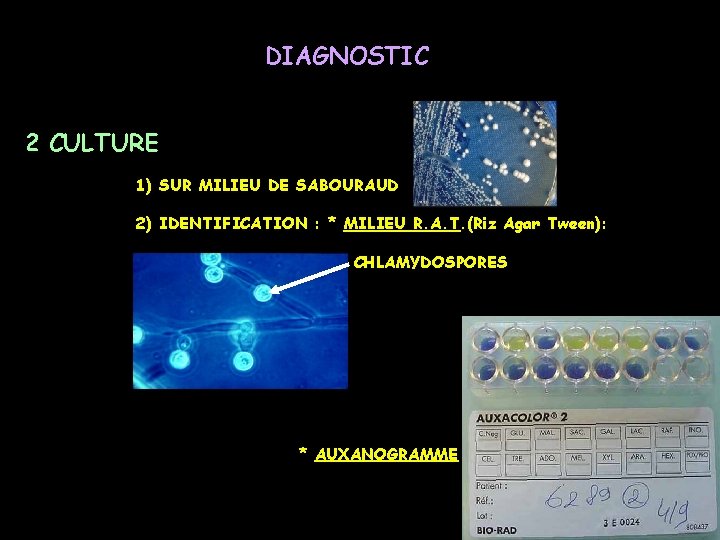 DIAGNOSTIC 2 CULTURE 1) SUR MILIEU DE SABOURAUD 2) IDENTIFICATION : * MILIEU R.