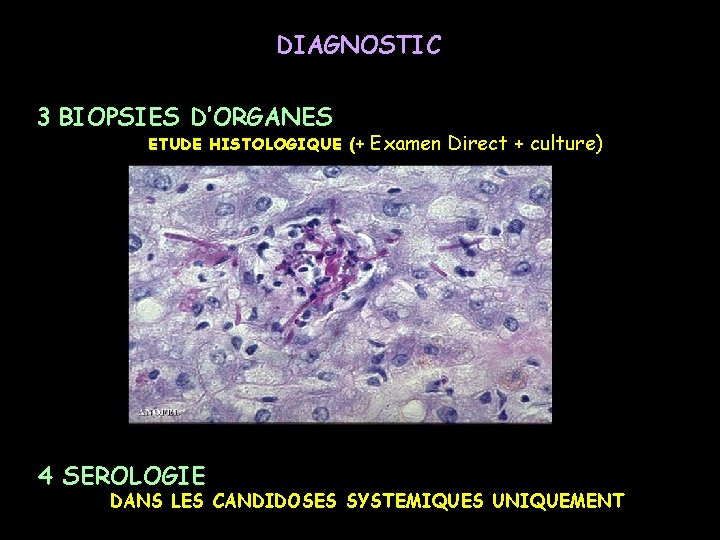 DIAGNOSTIC 3 BIOPSIES D’ORGANES ETUDE HISTOLOGIQUE (+ 4 SEROLOGIE Examen Direct + culture) DANS