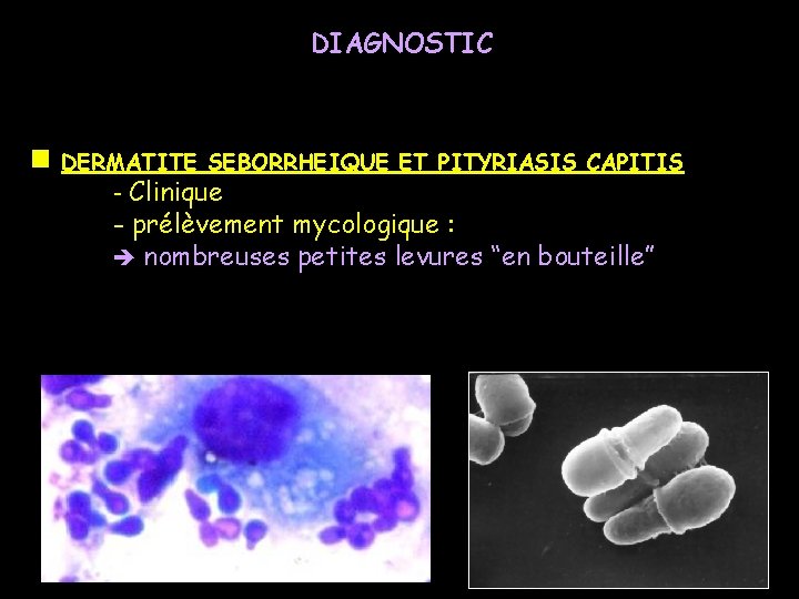 DIAGNOSTIC DERMATITE SEBORRHEIQUE ET PITYRIASIS CAPITIS - Clinique - prélèvement mycologique : nombreuses petites