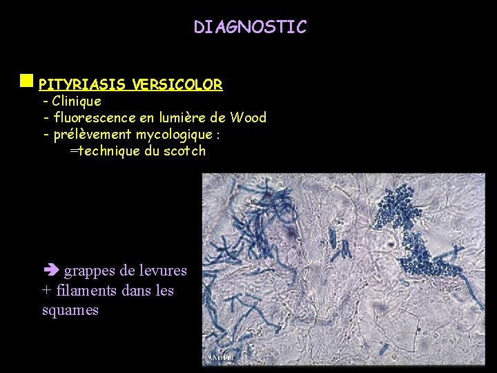 DIAGNOSTIC PITYRIASIS VERSICOLOR - Clinique - fluorescence en lumière de Wood - prélèvement mycologique