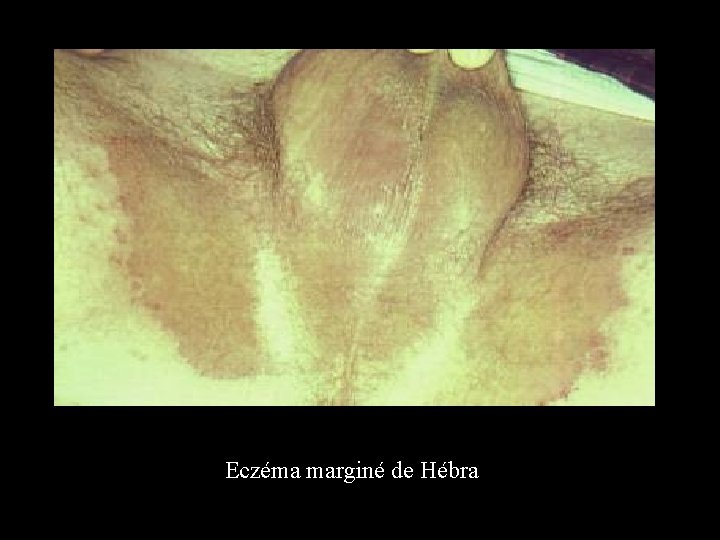 Eczéma marginé de Hébra 