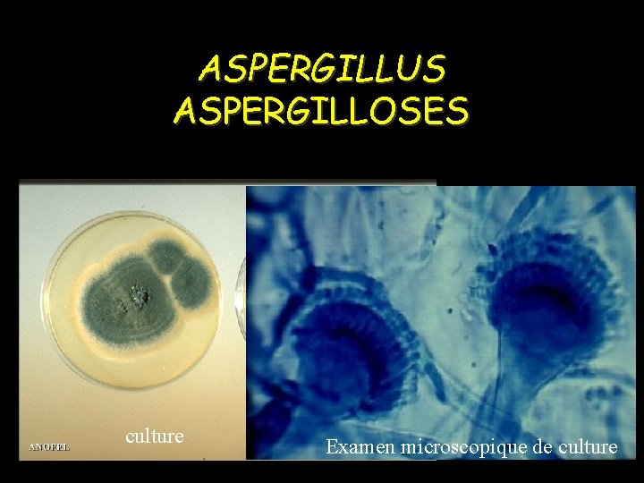 ASPERGILLUS ASPERGILLOSES Aspergillus fumigatus - opportuniste culture Examen microscopique de culture 