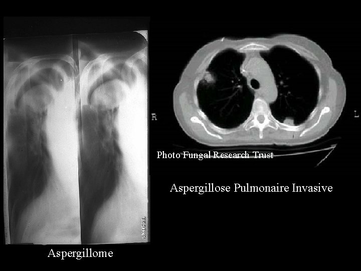 Photo Fungal Research Trust Aspergillose Pulmonaire Invasive Aspergillome 