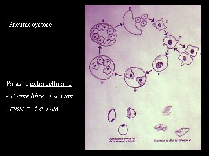 Pneumocystose Parasite extra cellulaire - Forme libre=1 à 3 μm - kyste = 5