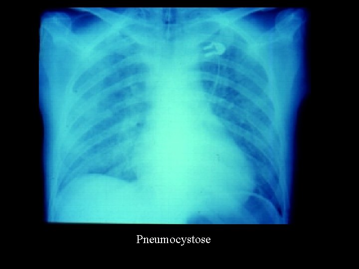 Pneumocystose 