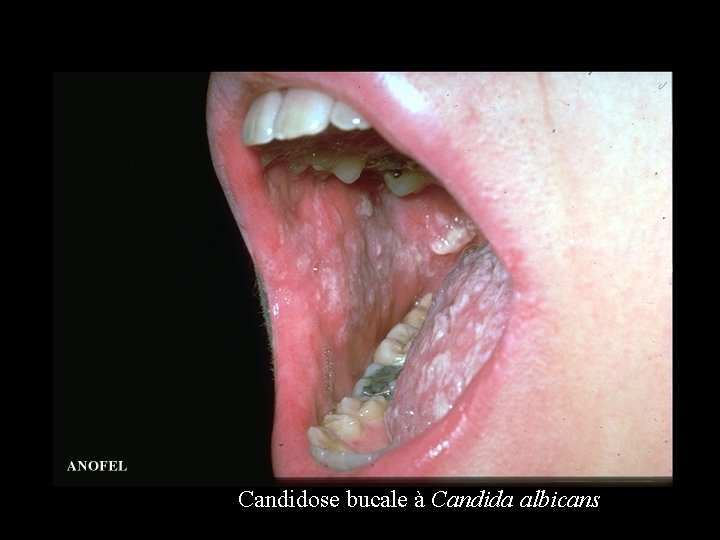 Candidose bucale à Candida albicans 