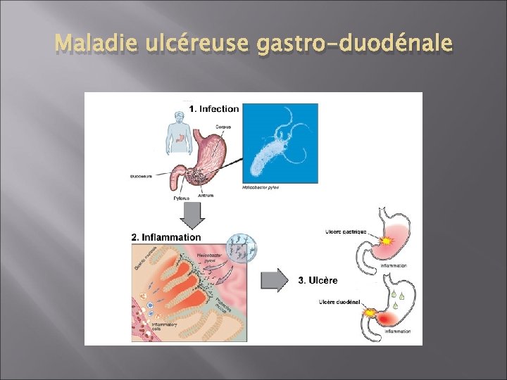 Maladie ulcéreuse gastro-duodénale 