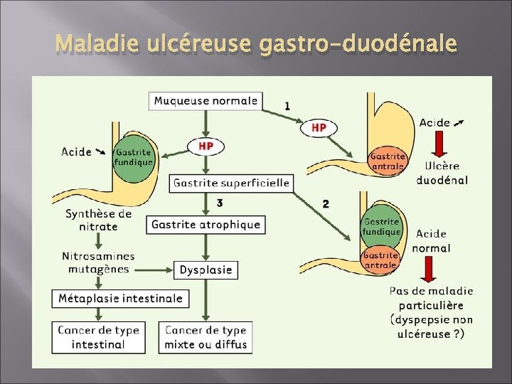 Maladie ulcéreuse gastro-duodénale 