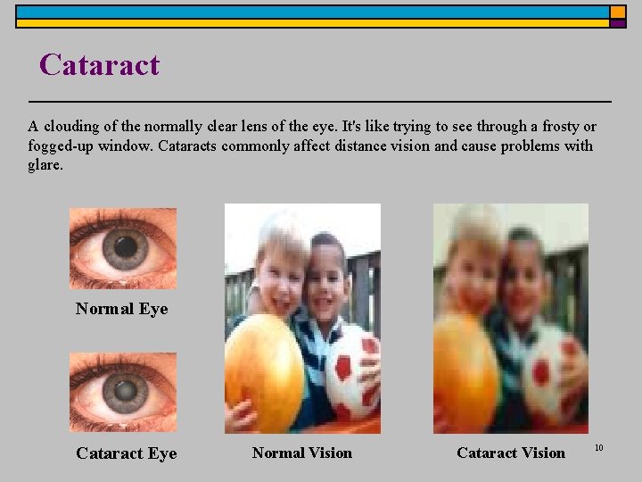Cataract A clouding of the normally clear lens of the eye. It's like trying Cataract A clouding of the normally clear lens of the eye. It's like trying
