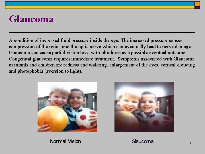 Glaucoma A condition of increased fluid pressure inside the eye. The increased pressure causes Glaucoma A condition of increased fluid pressure inside the eye. The increased pressure causes
