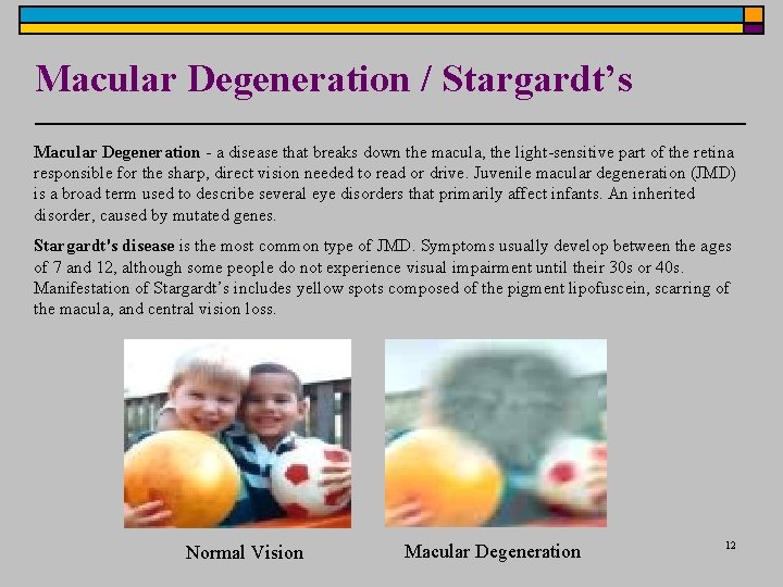 Macular Degeneration / Stargardt’s Macular Degeneration - a disease that breaks down the macula, Macular Degeneration / Stargardt’s Macular Degeneration - a disease that breaks down the macula,