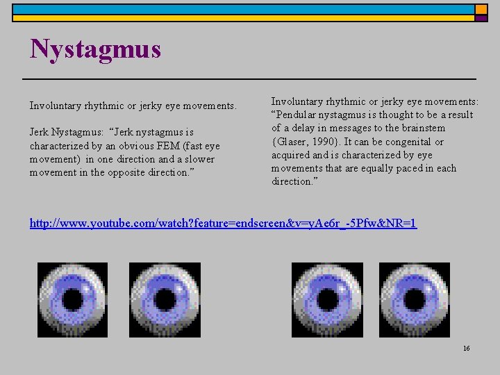 Nystagmus Involuntary rhythmic or jerky eye movements. Jerk Nystagmus: “Jerk nystagmus is characterized by Nystagmus Involuntary rhythmic or jerky eye movements. Jerk Nystagmus: “Jerk nystagmus is characterized by
