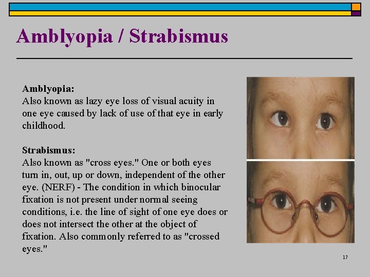 Amblyopia / Strabismus Amblyopia: Also known as lazy eye loss of visual acuity in Amblyopia / Strabismus Amblyopia: Also known as lazy eye loss of visual acuity in