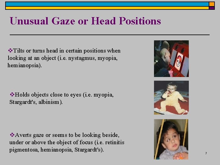 Unusual Gaze or Head Positions v. Tilts or turns head in certain positions when Unusual Gaze or Head Positions v. Tilts or turns head in certain positions when