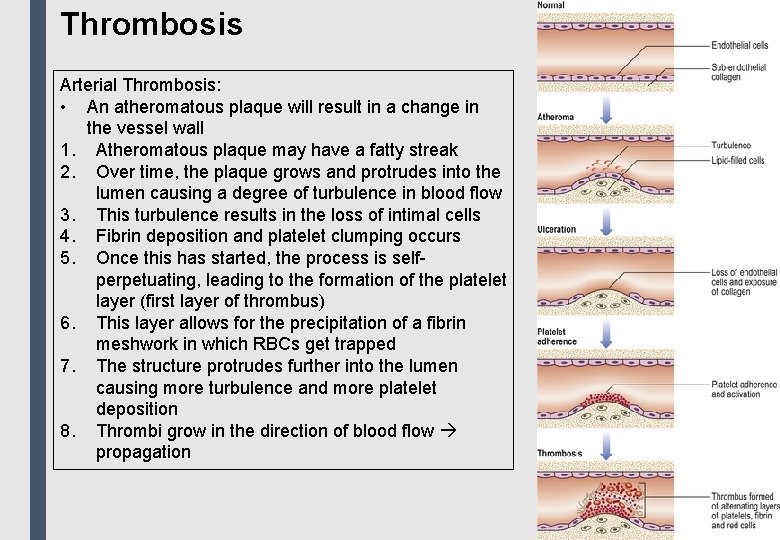 Thrombosis Arterial Thrombosis: • An atheromatous plaque will result in a change in the