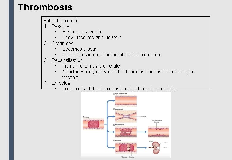 Thrombosis Fate of Thrombi: 1. Resolve • Best case scenario • Body dissolves and