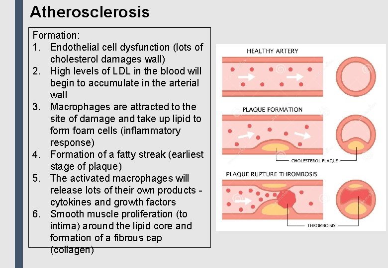Atherosclerosis Formation: 1. Endothelial cell dysfunction (lots of cholesterol damages wall) 2. High levels