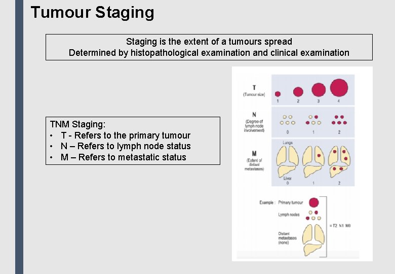 Tumour Staging is the extent of a tumours spread Determined by histopathological examination and