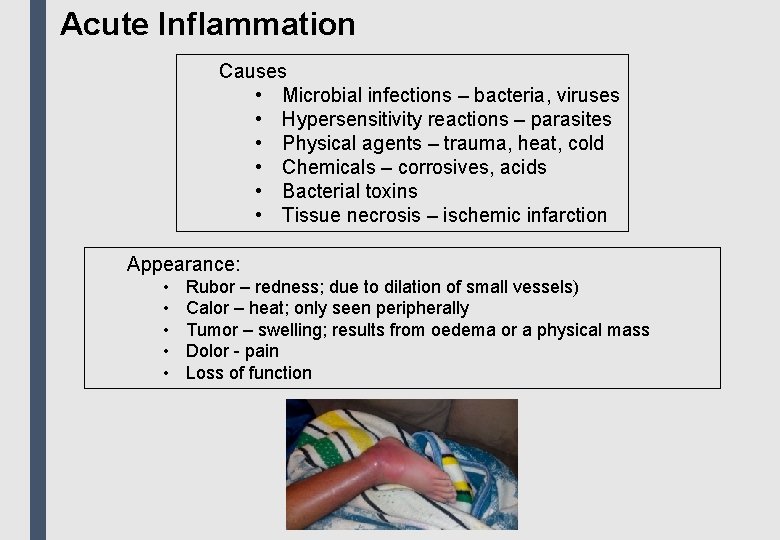 Acute Inflammation Causes • Microbial infections – bacteria, viruses • Hypersensitivity reactions – parasites