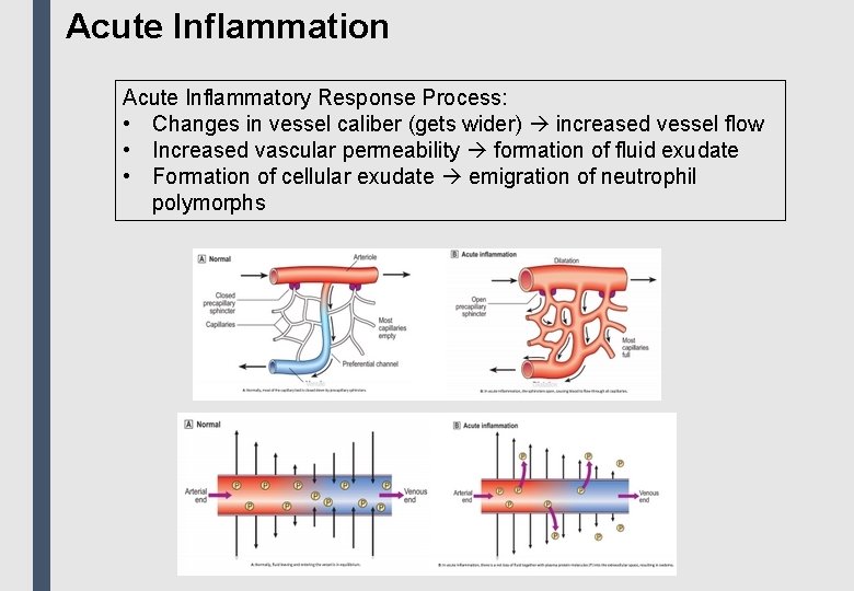 Acute Inflammation Acute Inflammatory Response Process: • Changes in vessel caliber (gets wider) increased