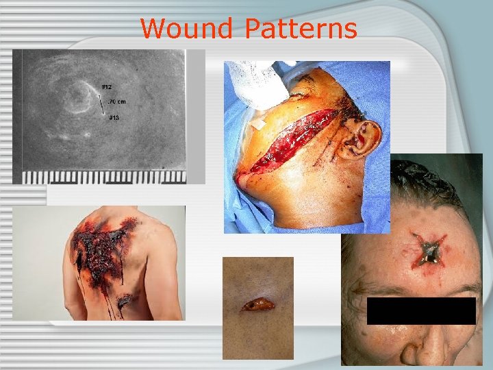 Wound Patterns 