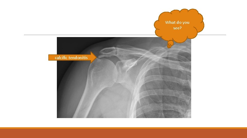What do you see? calcific tendonitis What do you see? calcific tendonitis