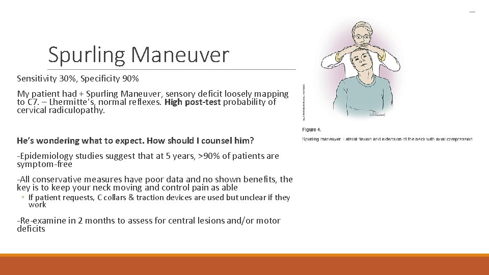 Spurling Maneuver Sensitivity 30%, Specificity 90% My patient had + Spurling Maneuver, sensory deficit