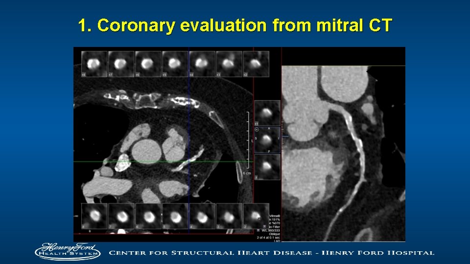 1. Coronary evaluation from mitral CT 