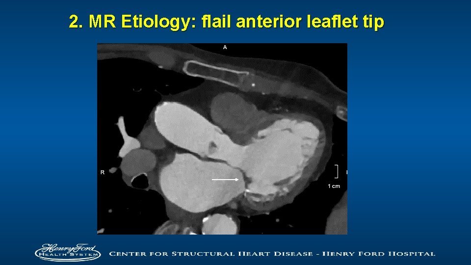 2. MR Etiology: flail anterior leaflet tip 