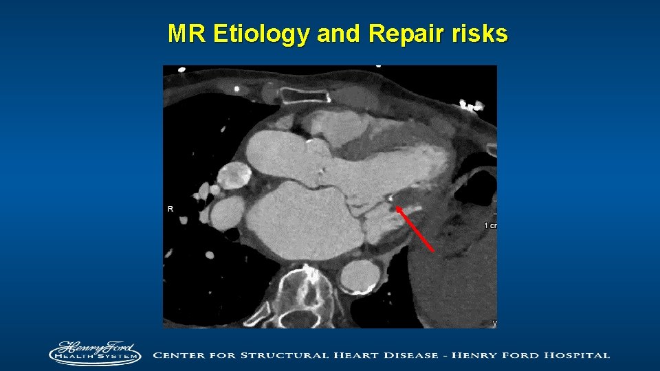 MR Etiology and Repair risks 