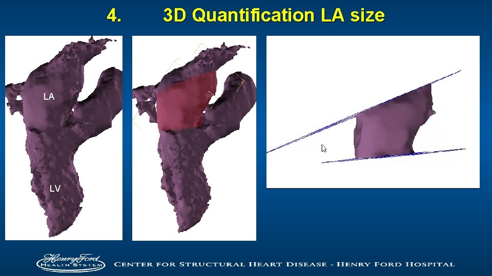 4. LA LV 3 D Quantification LA size 