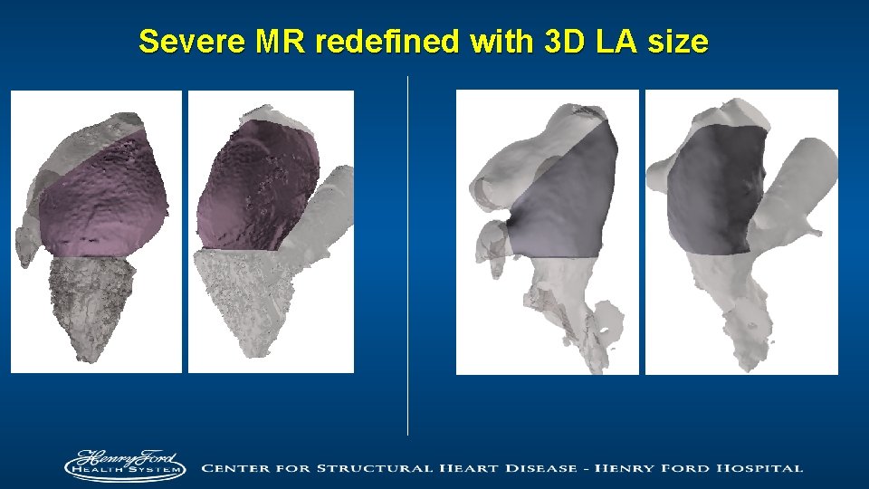 Severe MR redefined with 3 D LA size 