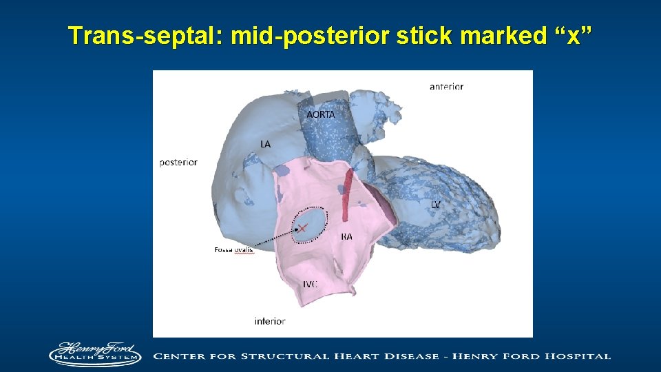 Trans-septal: mid-posterior stick marked “x” 