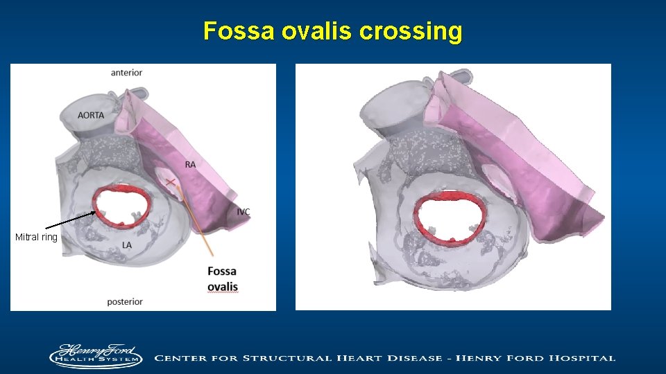 Fossa ovalis crossing Mitral ring 