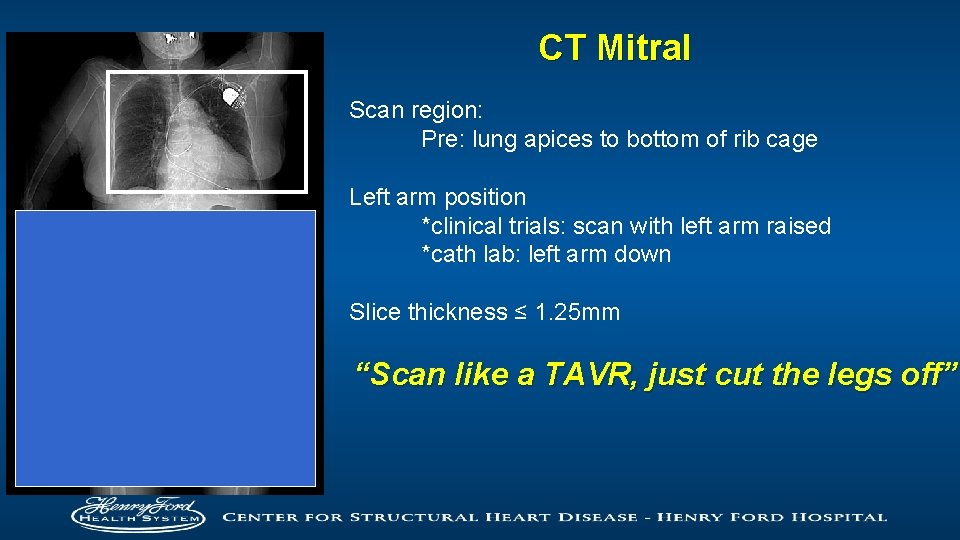 CT Mitral Scan region: Pre: lung apices to bottom of rib cage Left arm