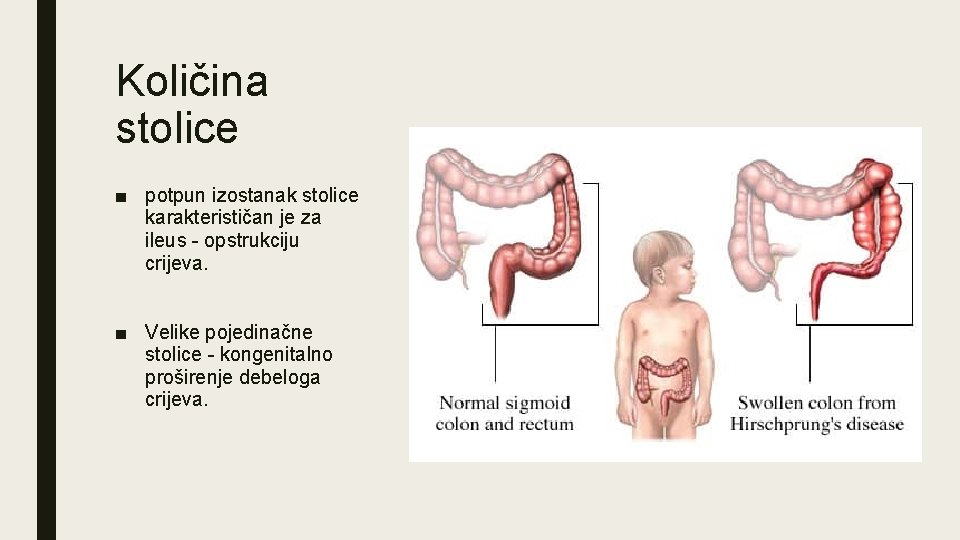 Količina stolice ■ potpun izostanak stolice karakterističan je za ileus - opstrukciju crijeva. ■