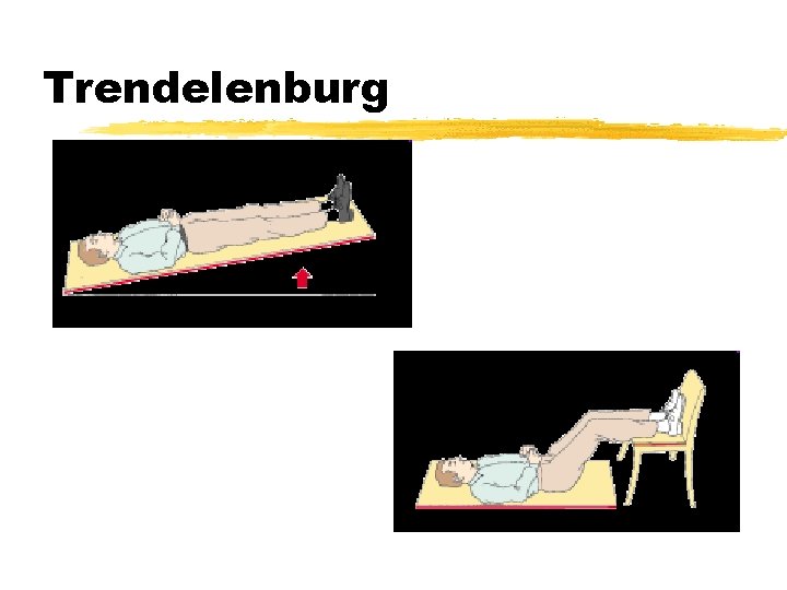 Trendelenburg 