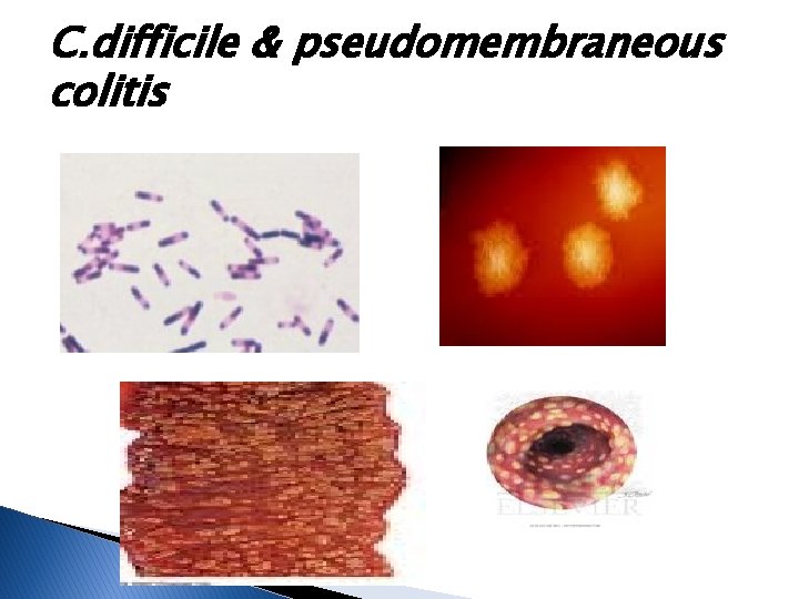 C. difficile & pseudomembraneous colitis 