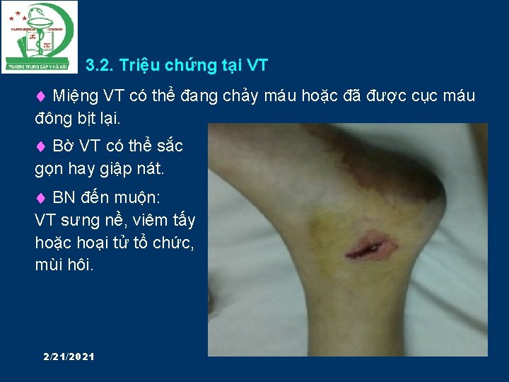 3. 2. Triệu chứng tại VT Miệng VT có thể đang chảy máu hoặc