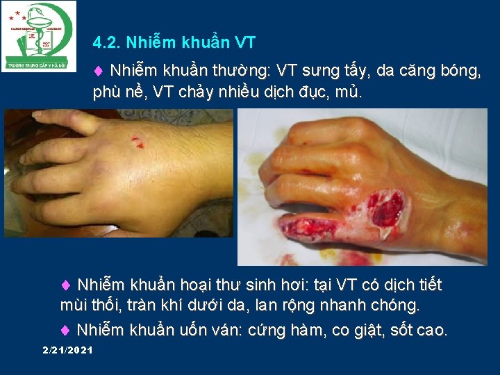 4. 2. Nhiễm khuẩn VT Nhiễm khuẩn thường: VT sưng tấy, da căng bóng,