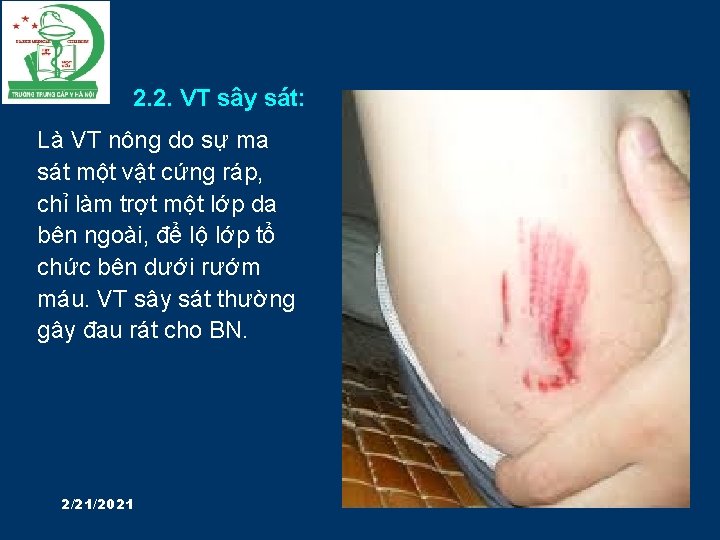 2. 2. VT sây sát: Là VT nông do sự ma sát một vật