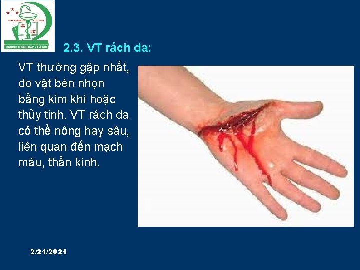 2. 3. VT rách da: VT thường gặp nhất, do vật bén nhọn bằng