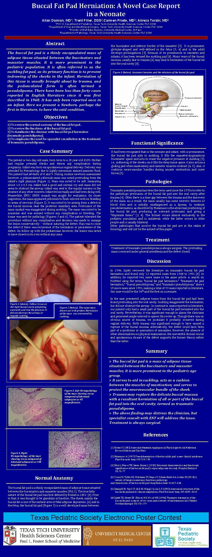 Buccal Fat Pad Herniation: A Novel Case Report in a Neonate Allan Damian, MD