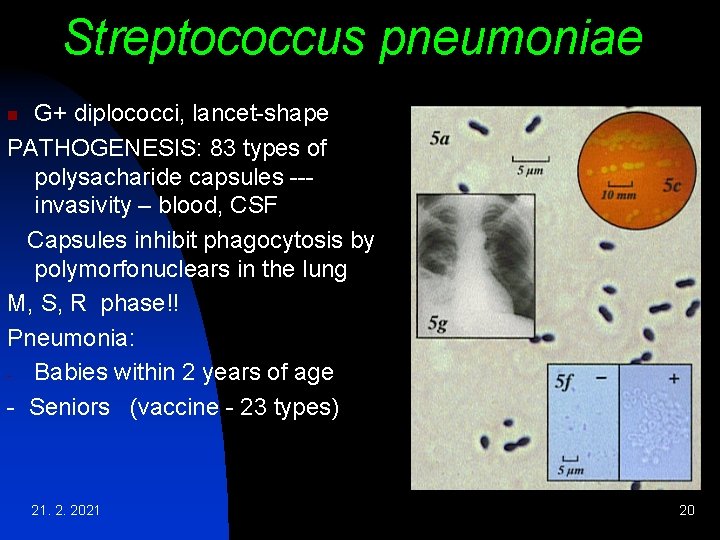 Streptococcus pneumoniae G+ diplococci, lancet-shape PATHOGENESIS: 83 types of polysacharide capsules --invasivity – blood, Streptococcus pneumoniae G+ diplococci, lancet-shape PATHOGENESIS: 83 types of polysacharide capsules --invasivity – blood,
