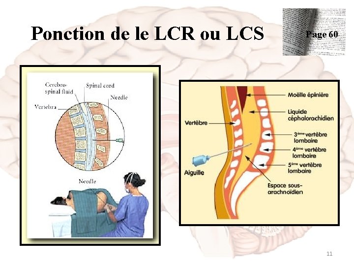 Ponction de le LCR ou LCS Page 60 11 