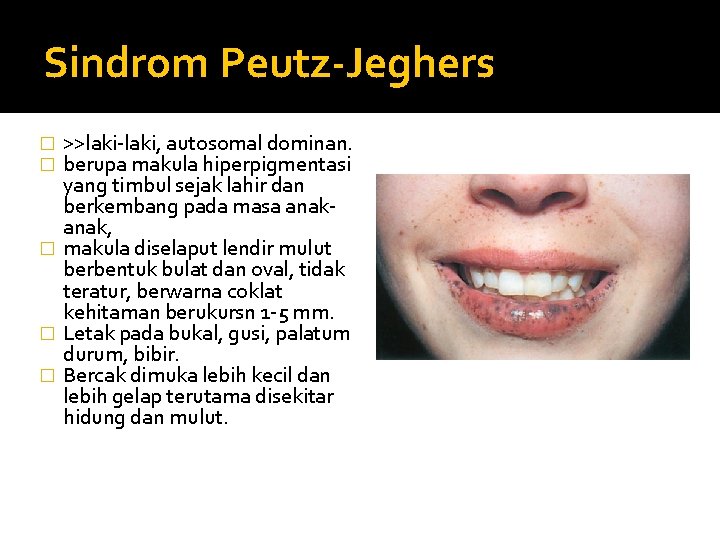 Sindrom Peutz-Jeghers >>laki-laki, autosomal dominan. berupa makula hiperpigmentasi yang timbul sejak lahir dan berkembang