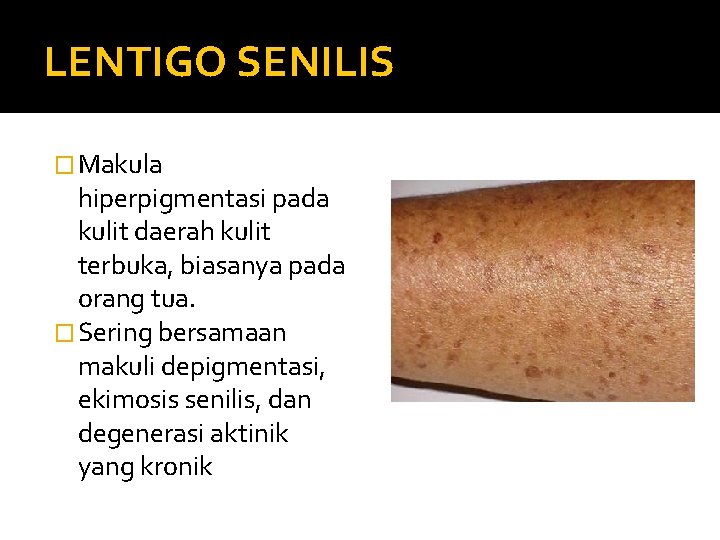 LENTIGO SENILIS � Makula hiperpigmentasi pada kulit daerah kulit terbuka, biasanya pada orang tua.