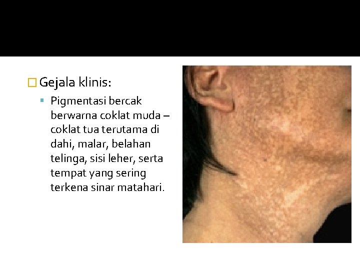 � Gejala klinis: Pigmentasi bercak berwarna coklat muda – coklat tua terutama di dahi,