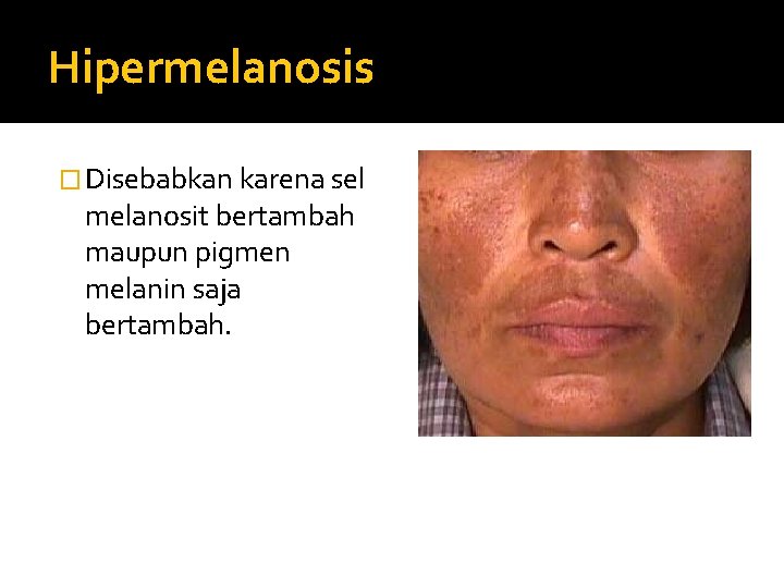Hipermelanosis � Disebabkan karena sel melanosit bertambah maupun pigmen melanin saja bertambah. 